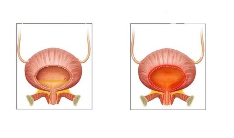 Gernu-traktuko zistitisa duten gaixoak