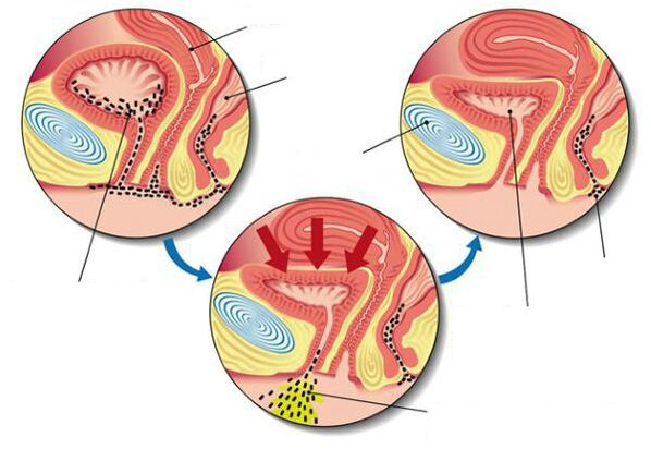zistitisa duten maskuriko bakterioak