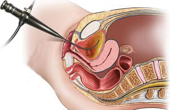 zistitisaren cistoskopia